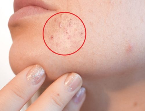 Jongeren (acne)behandeling